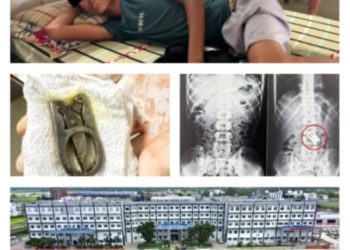 कैंची निलेका १५ वर्षीय बालकको नोवेल अस्पतालमा सफल शल्यक्रिया